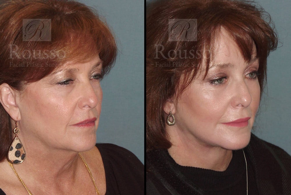 SculptLift™ Before & After Gallery - Patient 102905531 - Image 1