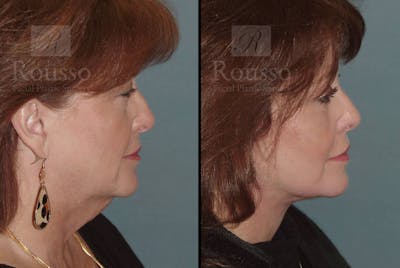 SculptLift™ Before & After Gallery - Patient 102905531 - Image 2