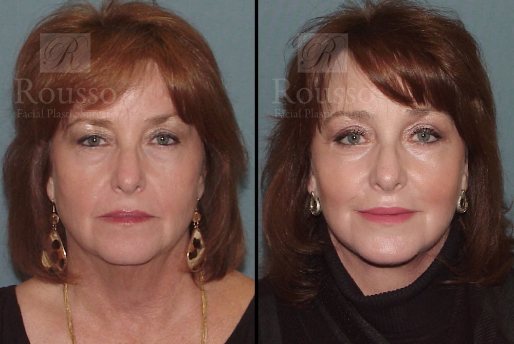 SculptLift™ Before & After Gallery - Patient 102905531 - Image 3