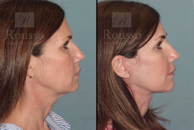 MiniLift Before & After Gallery - Patient 102905534 - Image 2