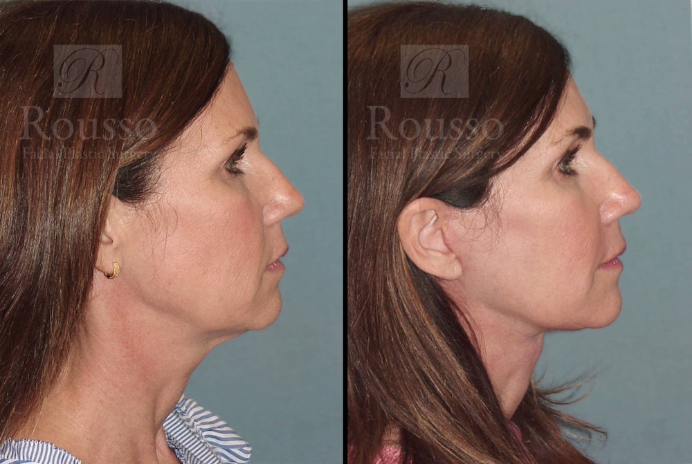 MiniLift Before & After Gallery - Patient 102905534 - Image 2
