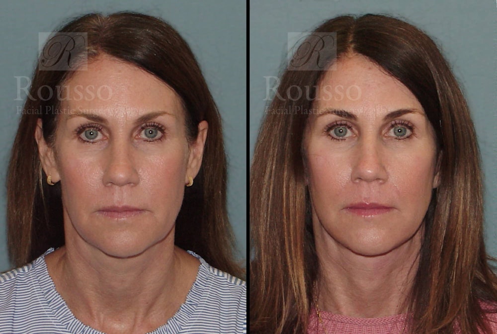 MiniLift Before & After Gallery - Patient 102905534 - Image 3