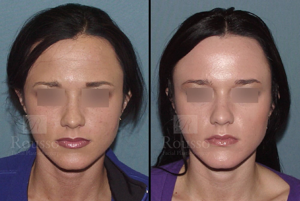 BOTOX Before & After Gallery - Patient 102925705 - Image 1