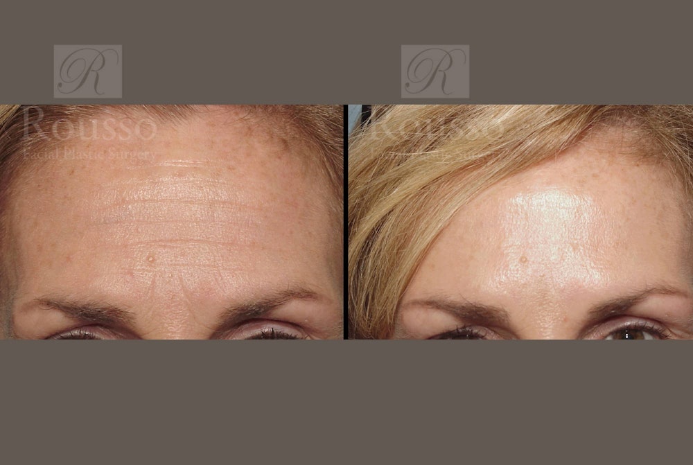 BOTOX Before & After Gallery - Patient 102925706 - Image 1
