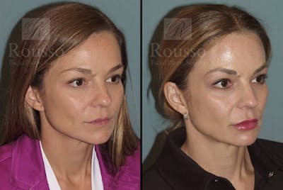 Fillers Gallery Before & After Gallery - Patient 102925718 - Image 1