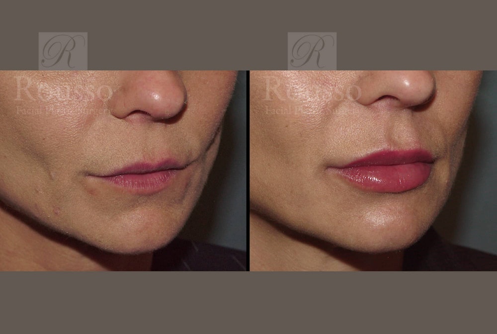 Fillers Before & After Gallery - Patient 102925718 - Image 2