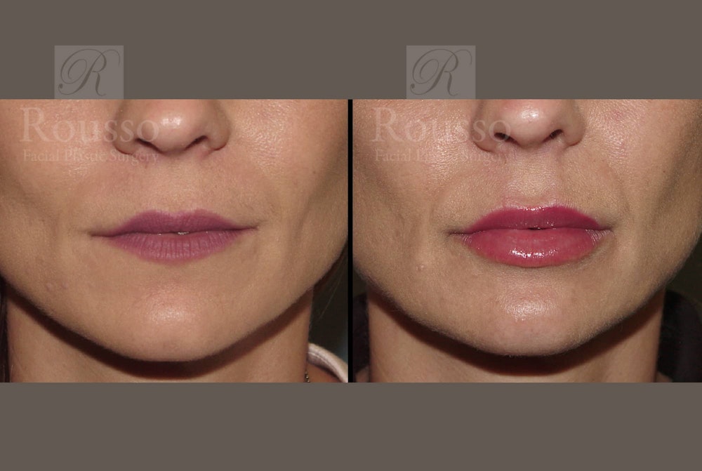 Fillers Before & After Gallery - Patient 102925718 - Image 3