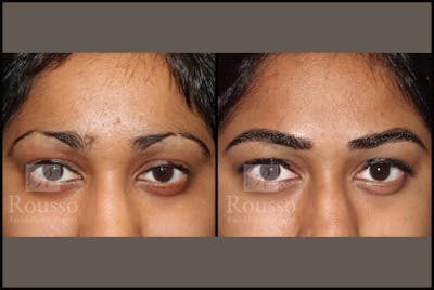 Microblading Before & After Gallery - Patient 102925755 - Image 1