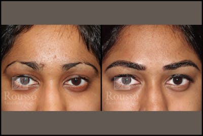 Microblading Gallery Before & After Gallery - Patient 102925755 - Image 1