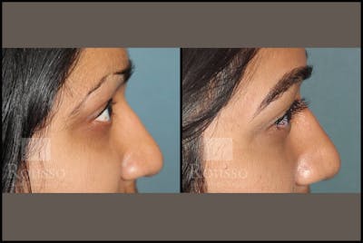 Microblading Gallery - Patient 102925755 - Image 2