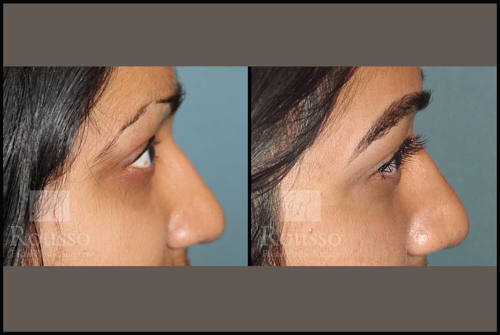 Microblading Gallery Before & After Gallery - Patient 102925755 - Image 2