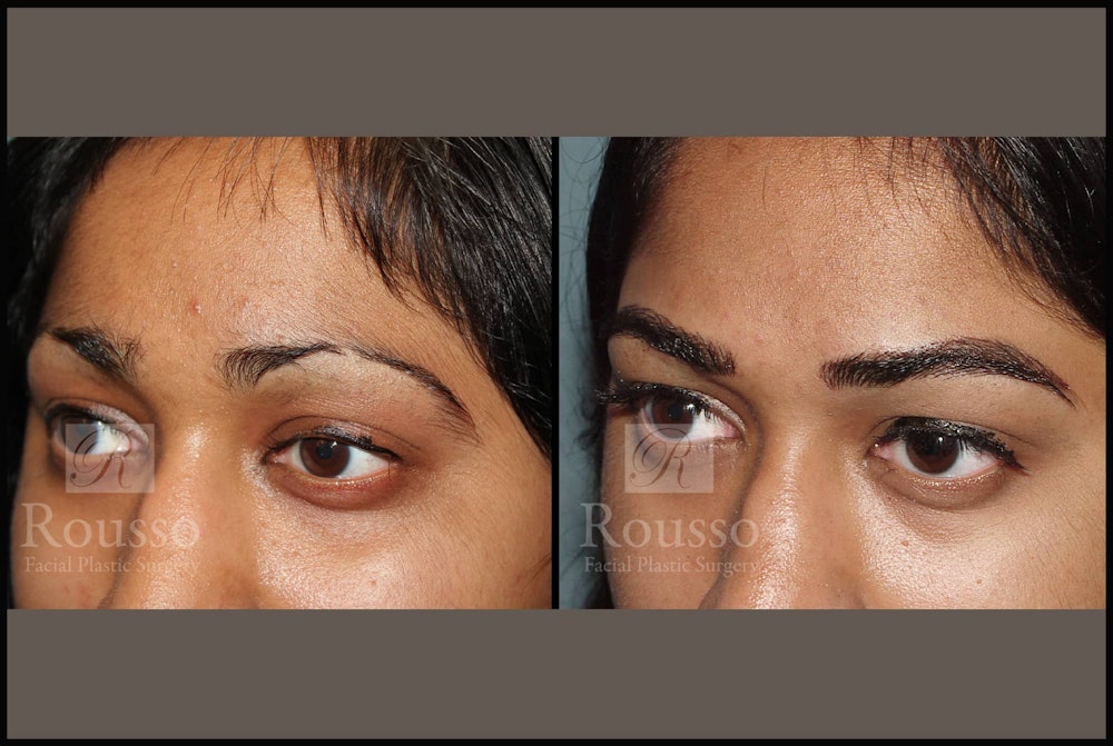 Microblading Gallery Before & After Gallery - Patient 102925755 - Image 3