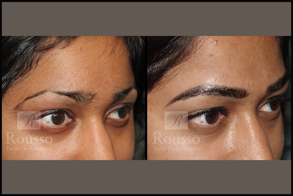 Microblading Gallery - Patient 102925755 - Image 4