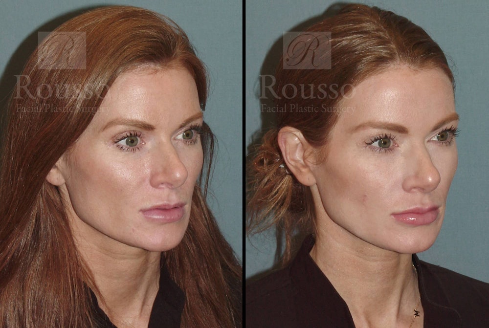 Fillers Gallery Before & After Gallery - Patient 102925965 - Image 1