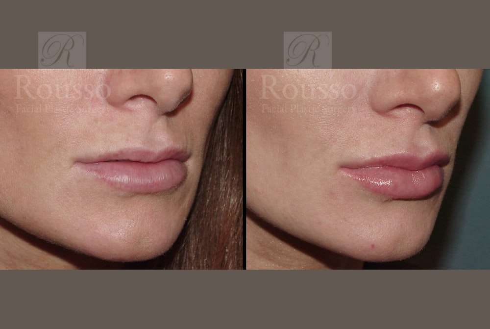 Fillers Before & After Gallery - Patient 102925965 - Image 2