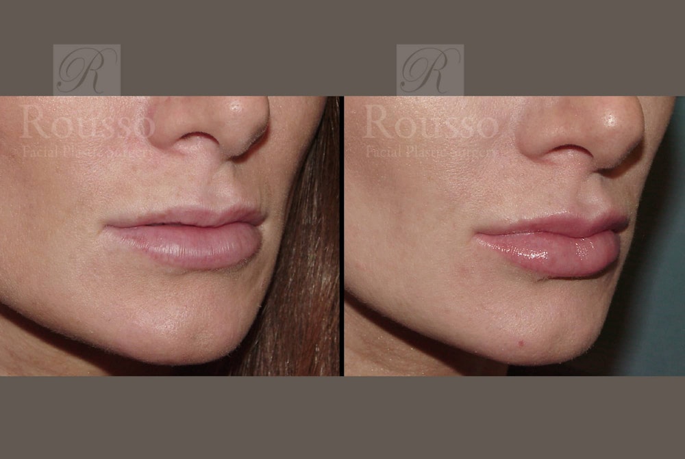 Fillers Gallery Before & After Gallery - Patient 102925965 - Image 2