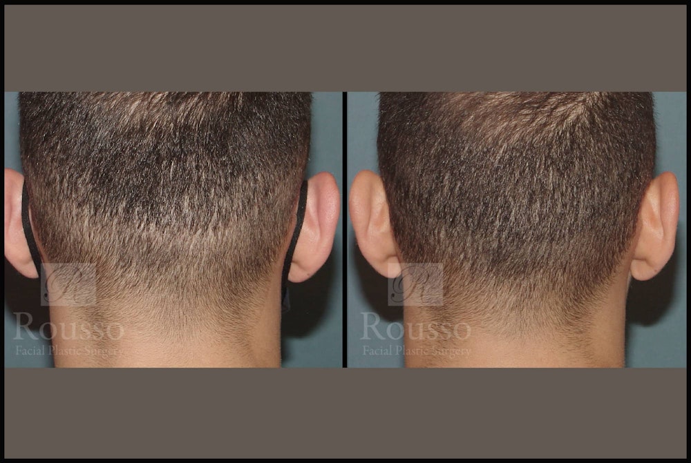 Scalp MicroPigmentation Before & After Gallery - Patient 102926180 - Image 1