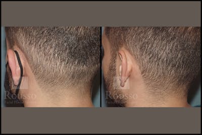Scalp MicroPigmentation Before & After Gallery - Patient 102926180 - Image 2