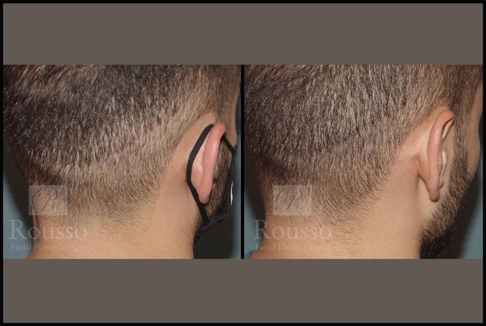 Scalp MicroPigmentation Before & After Gallery - Patient 102926180 - Image 3