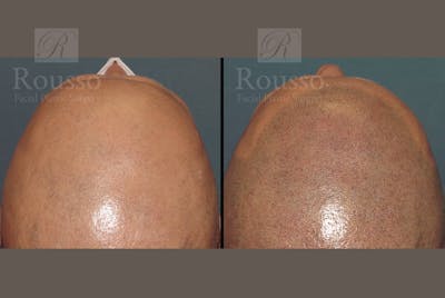 Scalp MicroPigmentation Before & After Gallery - Patient 102926181 - Image 1