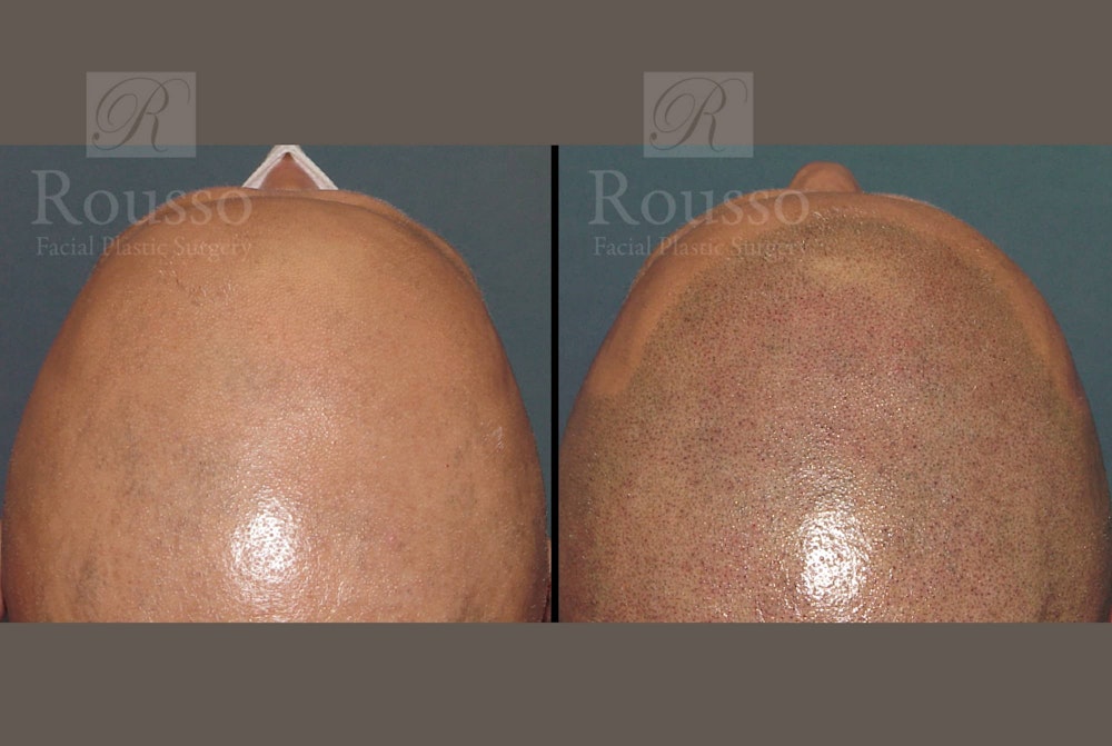 Scalp MicroPigmentation Before & After Gallery - Patient 102926181 - Image 1