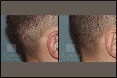 Scalp MicroPigmentation Before & After Gallery - Patient 102926180 - Image 4