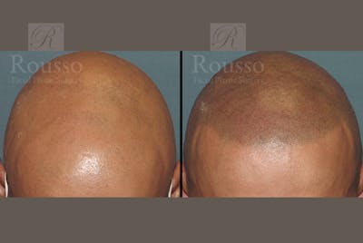 Scalp MicroPigmentation Before & After Gallery - Patient 102926181 - Image 2