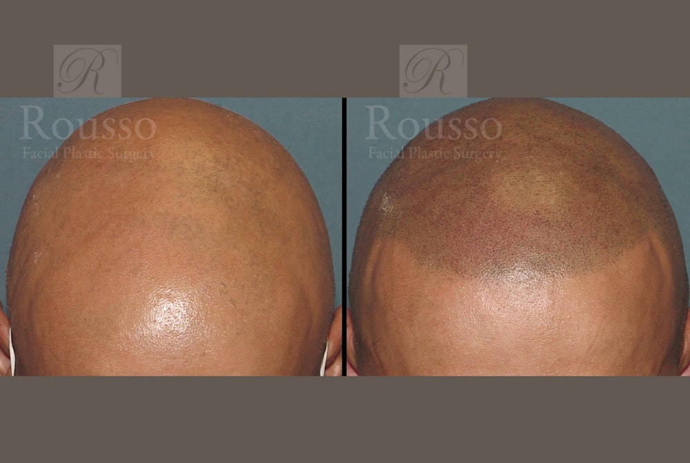 Scalp MicroPigmentation Before & After Gallery - Patient 102926181 - Image 2
