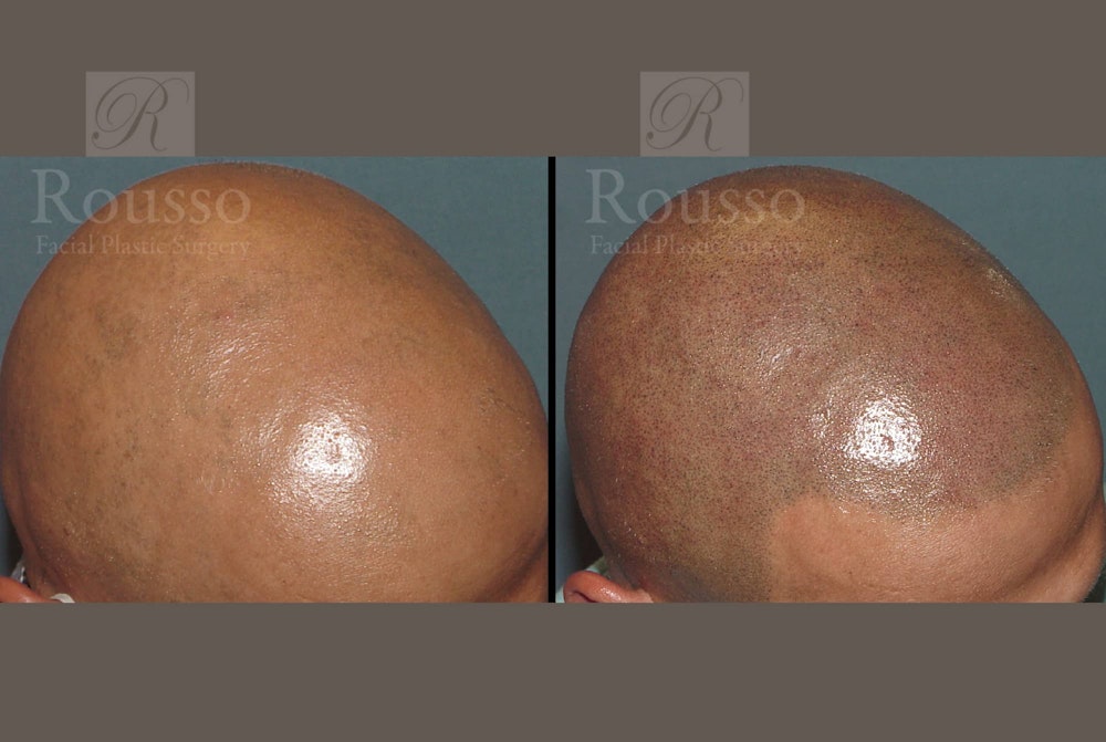 Scalp MicroPigmentation Before & After Gallery - Patient 102926181 - Image 3