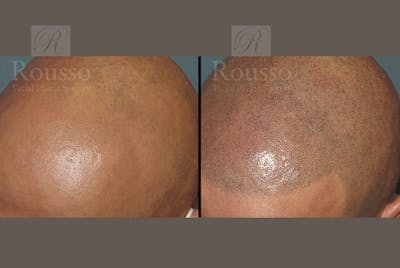 Scalp MicroPigmentation Before & After Gallery - Patient 102926181 - Image 4