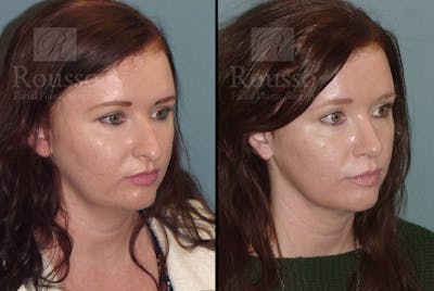 Rhinoplasty Before & After Gallery - Patient 105179945 - Image 1