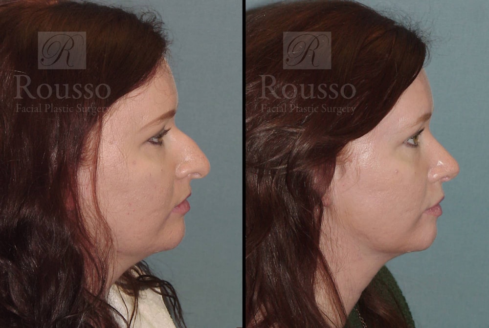 Rhinoplasty Before & After Gallery - Patient 105179945 - Image 2