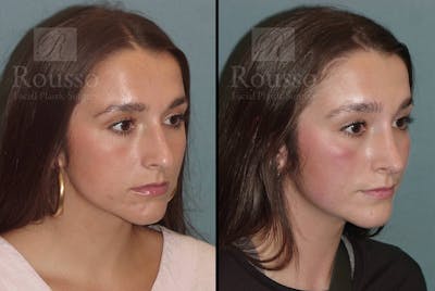 Rhinoplasty Before & After Gallery - Patient 105179946 - Image 1