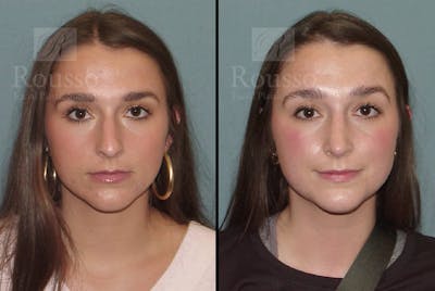 Rhinoplasty Before & After Gallery - Patient 105179946 - Image 2