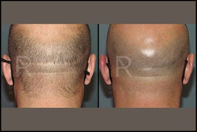 Scalp MicroPigmentation Before & After Gallery - Patient 116694738 - Image 1