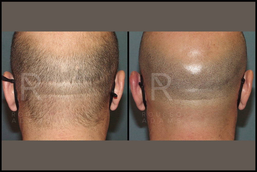 Scalp MicroPigmentation Before & After Gallery - Patient 116694738 - Image 1