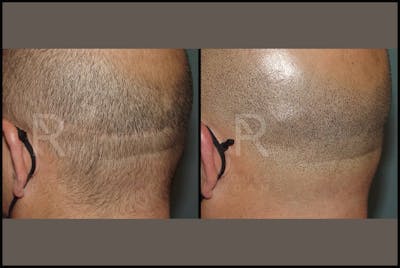 Scalp MicroPigmentation Before & After Gallery - Patient 116694738 - Image 2