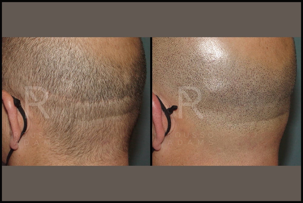 Scalp MicroPigmentation Before & After Gallery - Patient 116694738 - Image 2