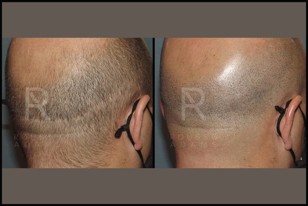 Scalp MicroPigmentation Before & After Gallery - Patient 116694738 - Image 3