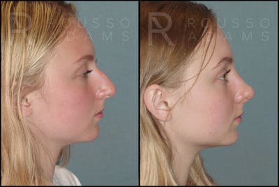 Rhinoplasty <span class=small>By Dr. Daniel Rousso</span> Before & After Gallery - Patient 121502986 - Image 1