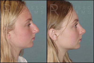 Rhinoplasty Before & After Gallery - Patient 121502986 - Image 1