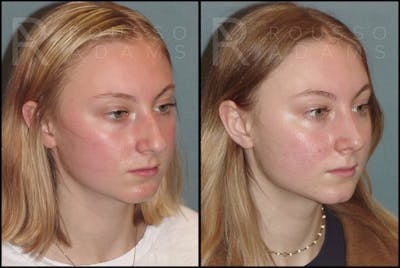 Rhinoplasty <span class=small>By Dr. Daniel Rousso</span> Before & After Gallery - Patient 121502986 - Image 2