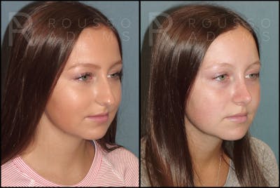 Rhinoplasty <span class=small>By Dr. Daniel Rousso</span> Before & After Gallery - Patient 121502987 - Image 2