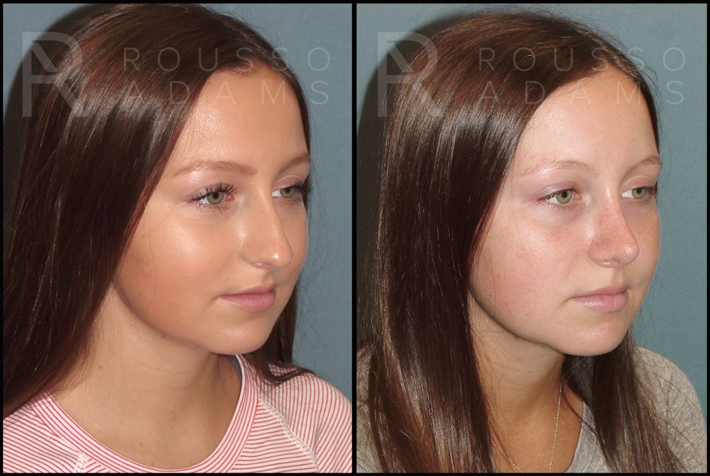 Rhinoplasty Before & After Gallery - Patient 121502987 - Image 1