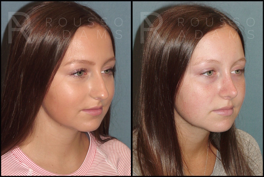 Rhinoplasty <span class=small>By Dr. Daniel Rousso</span> Before & After Gallery - Patient 121502987 - Image 2