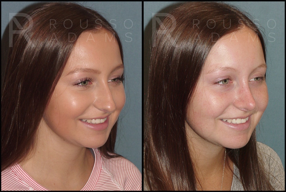 Rhinoplasty <span class=small>By Dr. Daniel Rousso</span> Before & After Gallery - Patient 121502987 - Image 3