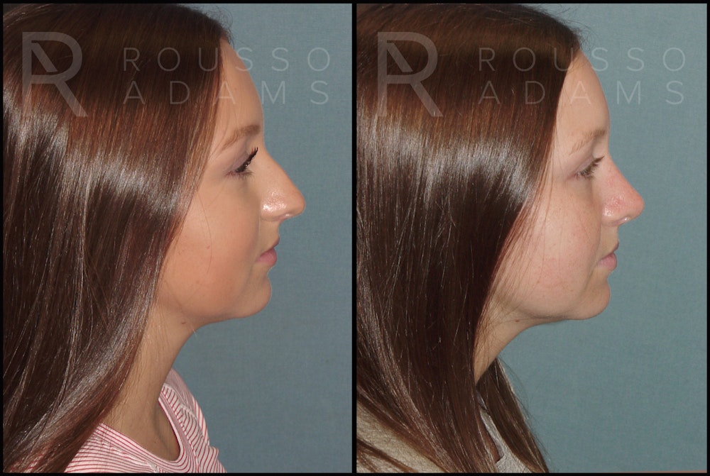 Rhinoplasty <span class=small>By Dr. Daniel Rousso</span> Before & After Gallery - Patient 121502987 - Image 1