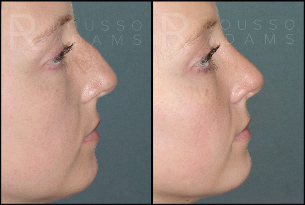 Rhinoplasty Before & After Gallery - Patient 121502988 - Image 3