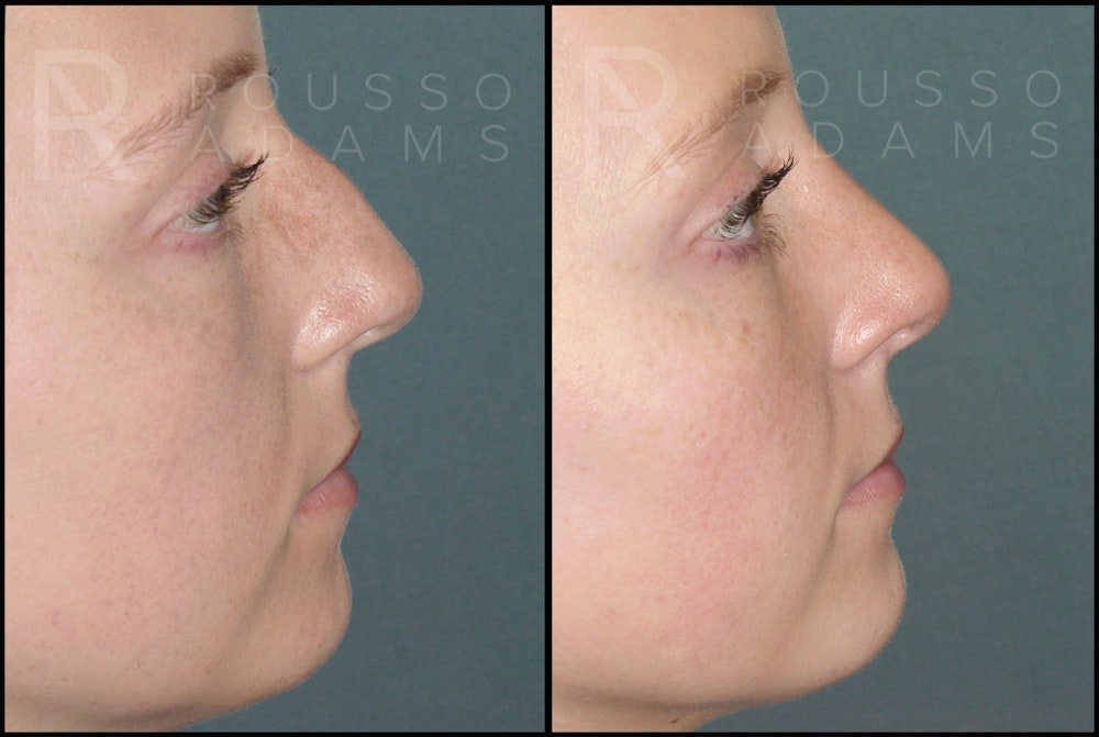 Rhinoplasty <span class=small>By Dr. Daniel Rousso</span> Before & After Gallery - Patient 121502988 - Image 3