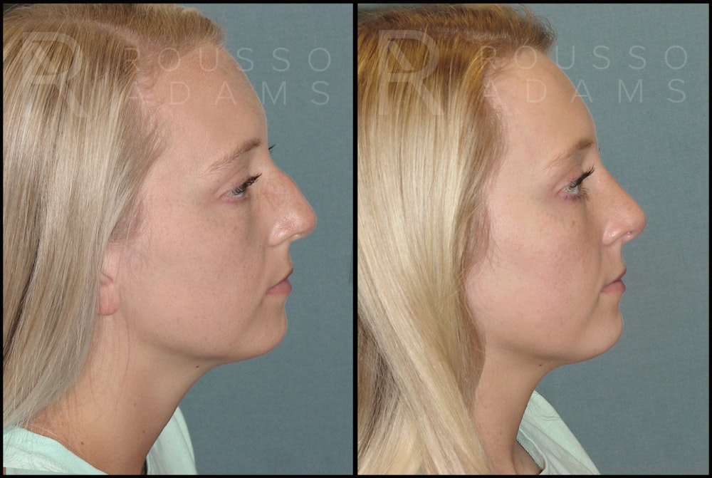 Rhinoplasty Before & After Gallery - Patient 121502988 - Image 2